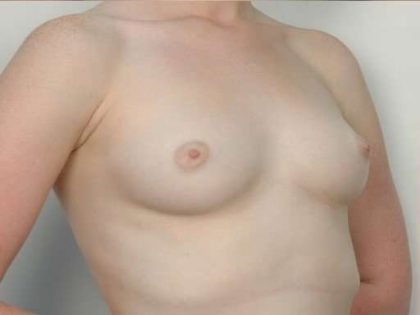Breast Augmentation Before & After Patient #611
