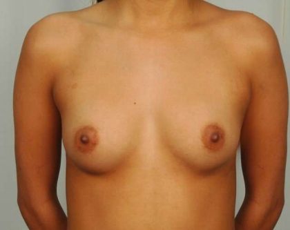 Breast Augmentation Before & After Patient #626