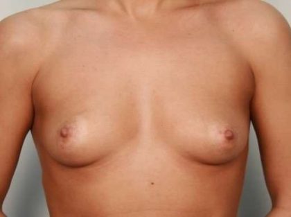 Breast Augmentation Before & After Patient #631