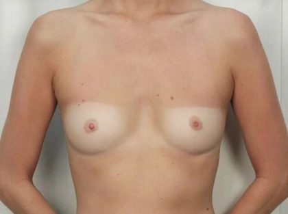 Breast Augmentation Before & After Patient #666