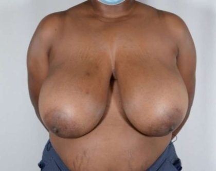 Breast Reduction Before & After Patient #781