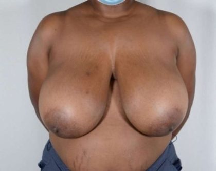 Breast Reduction Before & After Patient #821