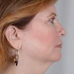 Facelift Before & After Patient #913