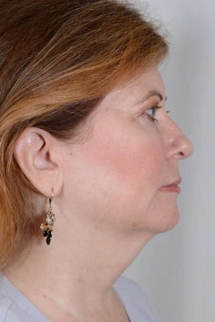 Facelift Before & After Patient #913