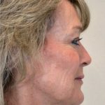 Facelift Before & After Patient #918