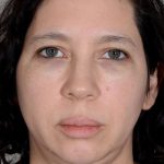 Facelift Before & After Patient #923
