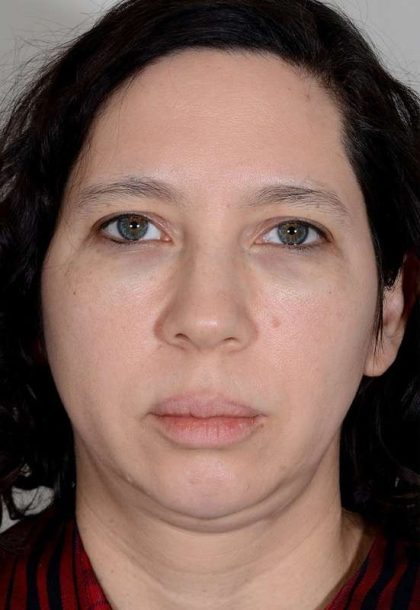 Facelift Before & After Patient #923