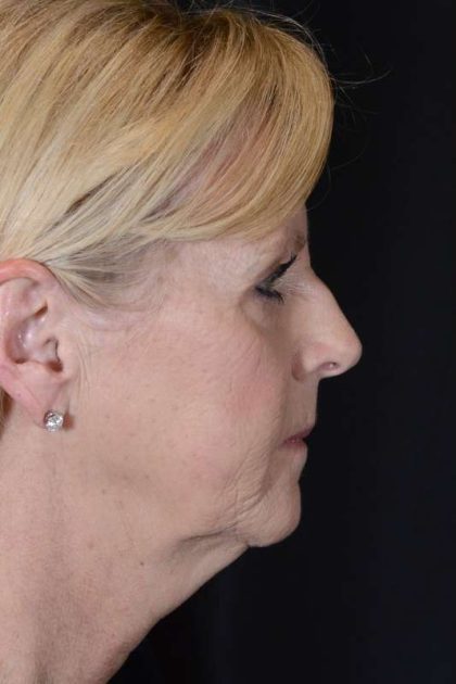 Facelift Before & After Patient #928