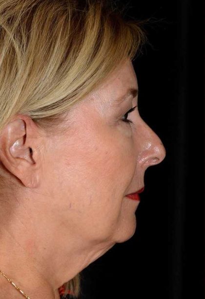 Facelift Before & After Patient #933