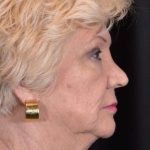 Facelift Before & After Patient #938