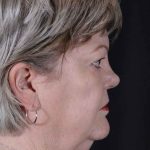 Facelift Before & After Patient #943