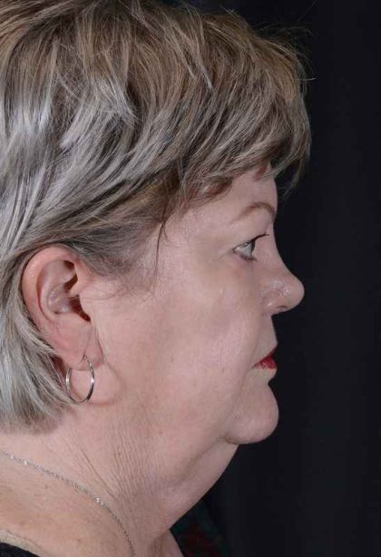 Facelift Before & After Patient #943