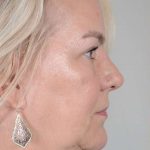 Facelift Before & After Patient #948