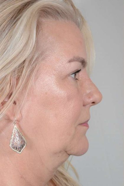 Facelift Before & After Patient #948