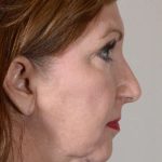 Facelift Before & After Patient #963