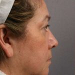 Facelift Before & After Patient #973