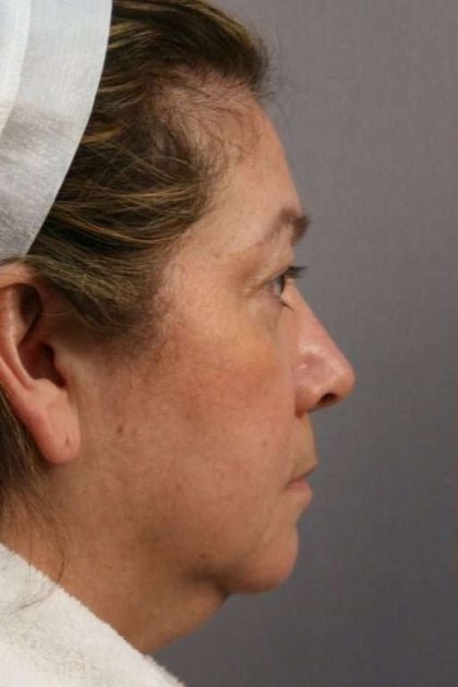 Facelift Before & After Patient #973