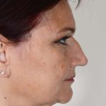 Facelift Before & After Patient #978