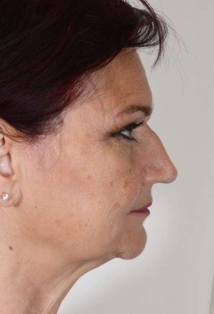 Facelift Before & After Patient #978