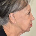 Facelift Before & After Patient #988