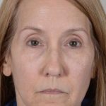 Facelift Before & After Patient #993