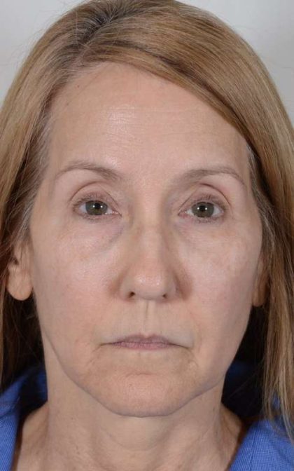 Facelift Before & After Patient #993