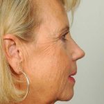 Facelift Before & After Patient #998