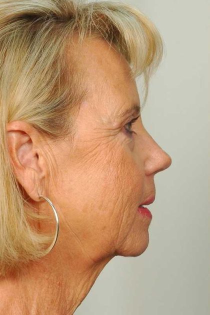Facelift Before & After Patient #998