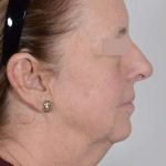 Facelift Before & After Patient #1008