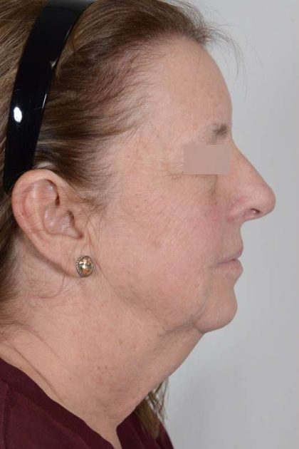 Facelift Before & After Patient #1008