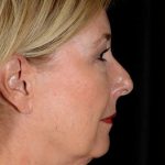 Facelift Before & After Patient #1013