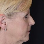 Facelift Before & After Patient #1018