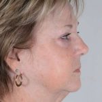 Facelift Before & After Patient #1023