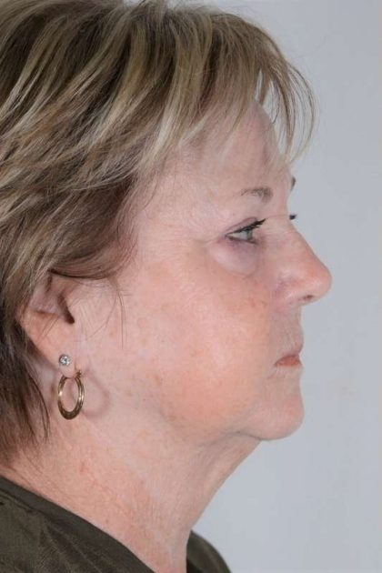Facelift Before & After Patient #1023