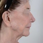 Facelift Before & After Patient #1028