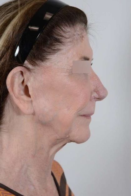 Facelift Before & After Patient #1028