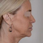 Facelift Before & After Patient #1033