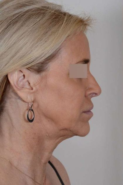 Facelift Before & After Patient #1033