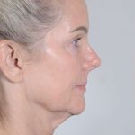 Facelift Before & After Patient #1038