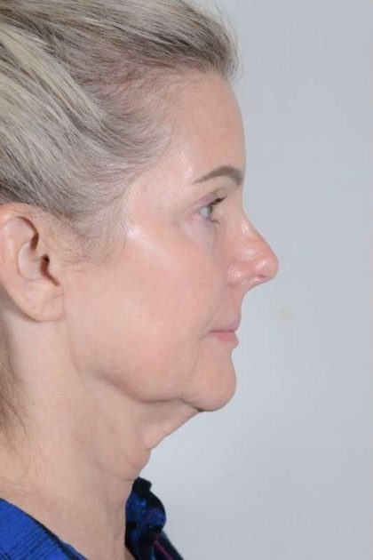 Facelift Before & After Patient #1038