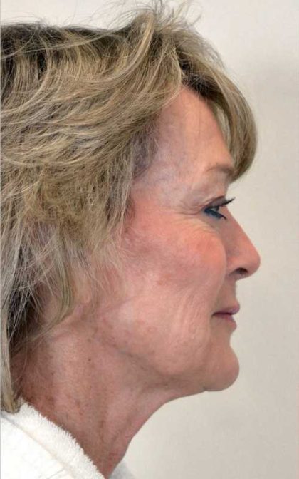 Neck Lift Before & After Patient #1080