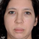 Neck Lift Before & After Patient #1085