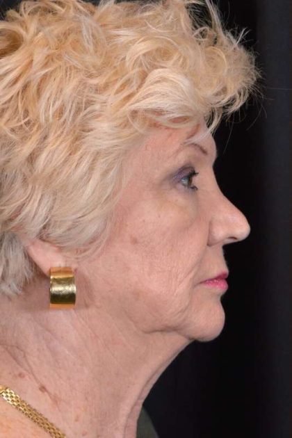 Neck Lift Before & After Patient #1100