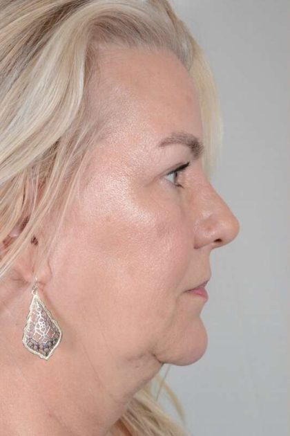 Neck Lift Before & After Patient #1110