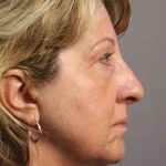 Neck Lift Before & After Patient #1115