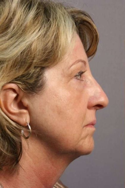 Neck Lift Before & After Patient #1115