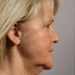 Neck Lift Before & After Patient #1120
