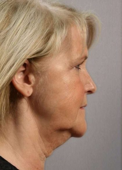 Neck Lift Before & After Patient #1120
