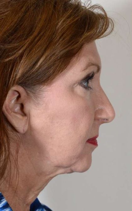 Neck Lift Before & After Patient #1125