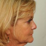 Neck Lift Before & After Patient #1130